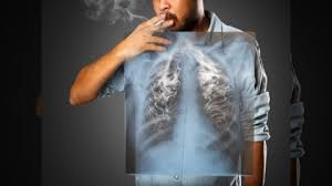 Kesehatan Paru-Paru Cara Bersihin Napas di Dunia yang Penuh Polusi